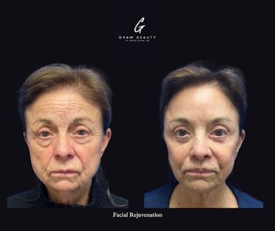 Face and Neck Before & After Gallery - Patient 682464 - Image 1