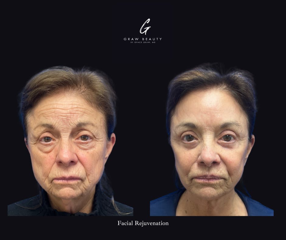 before image of facial rejuvenation patient