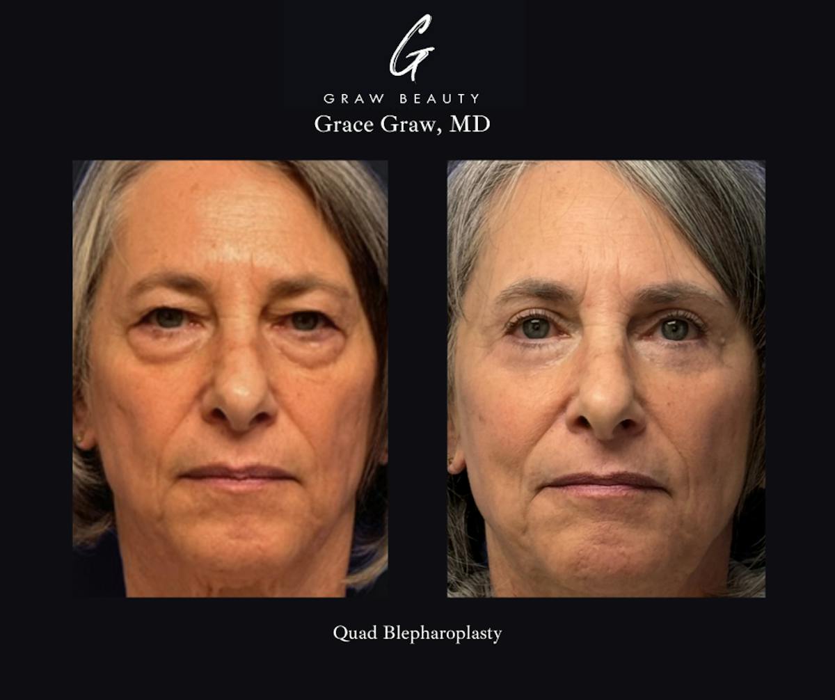 Eyelids Before & After Gallery - Patient 386162 - Image 1
