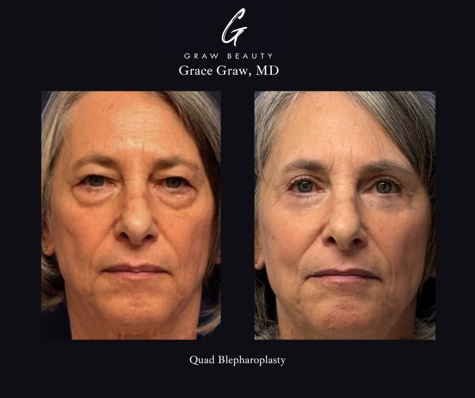 before image of quad blepharoplasty patient