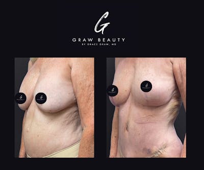 Fat Grafting Before & After Gallery - Patient 316167 - Image 1
