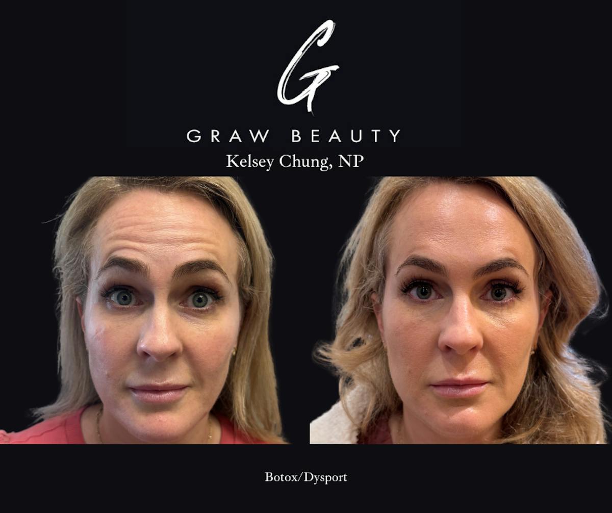 Face and Neck Before & After Gallery - Patient 255336 - Image 1