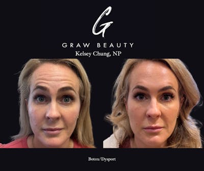 Face and Neck Before & After Gallery - Patient 255336 - Image 1