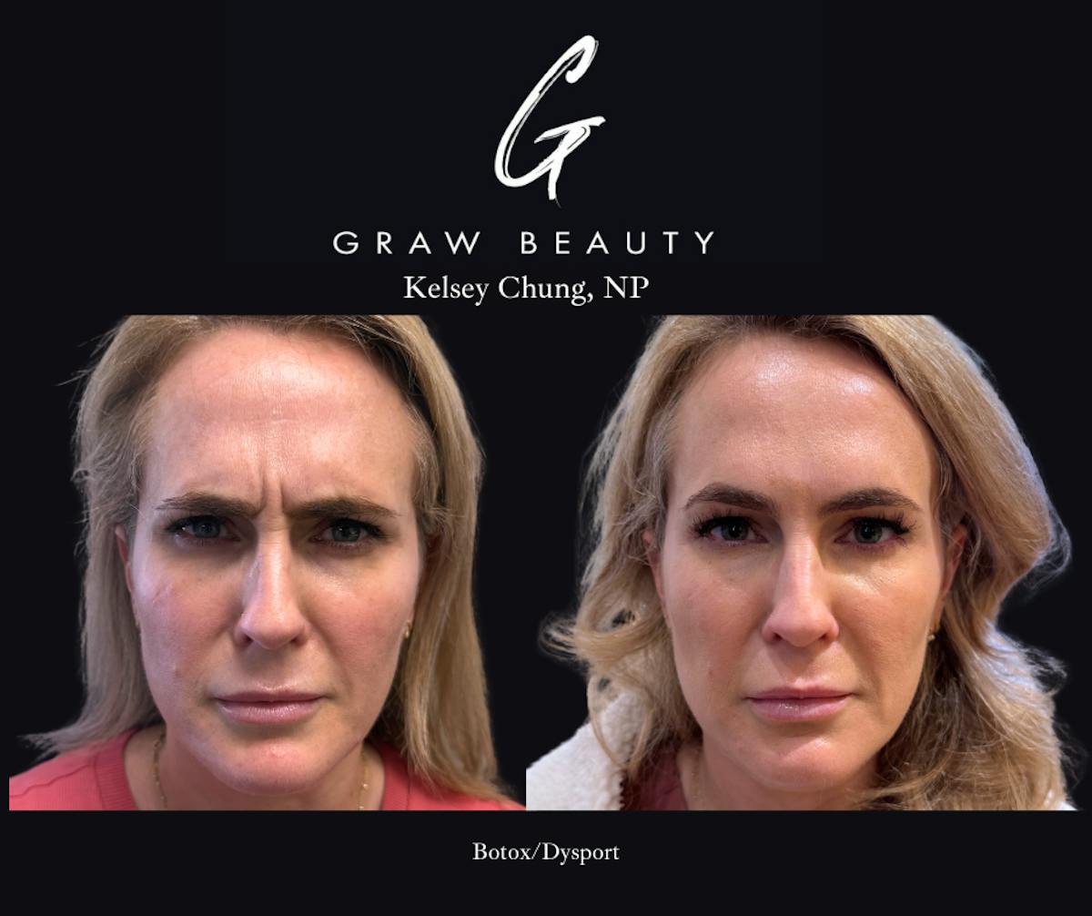 Face and Neck Before & After Gallery - Patient 255336 - Image 2