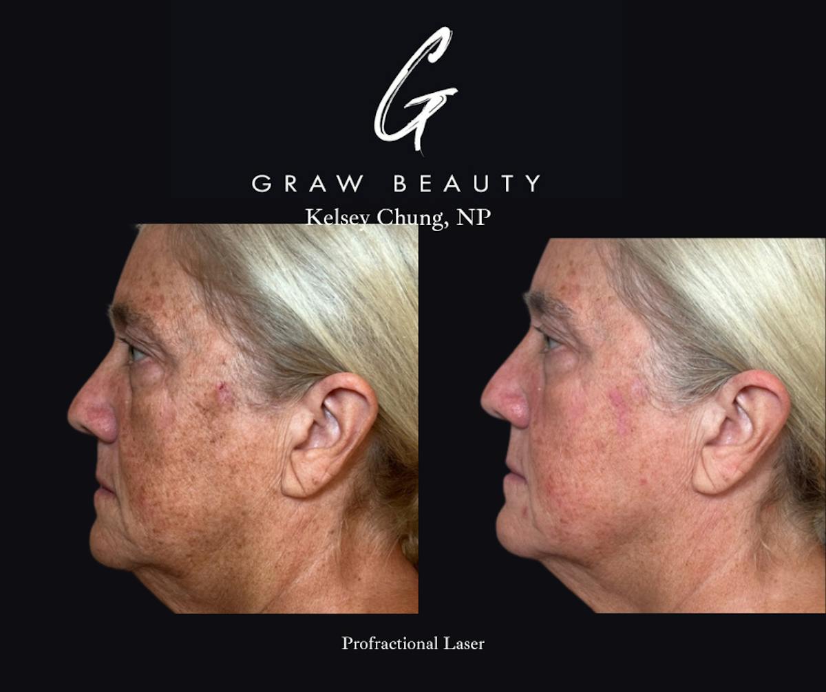 Face and Neck Before & After Gallery - Patient 325047 - Image 3