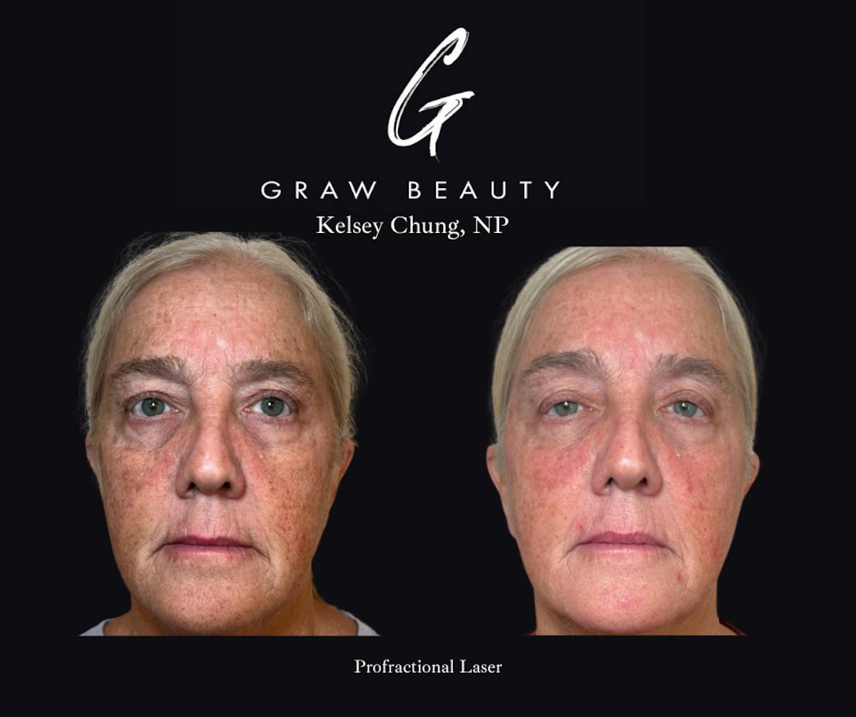 Face and Neck Before & After Gallery - Patient 325047 - Image 1