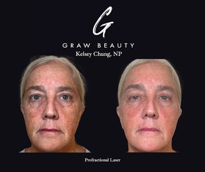 Face and Neck Before & After Gallery - Patient 325047 - Image 1