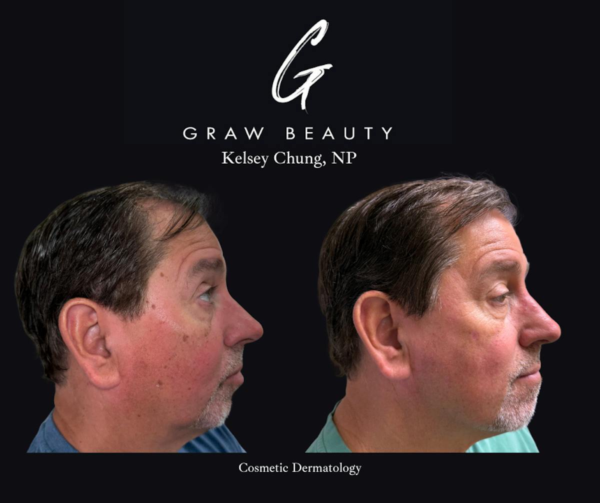 Face and Neck Before & After Gallery - Patient 450733 - Image 2