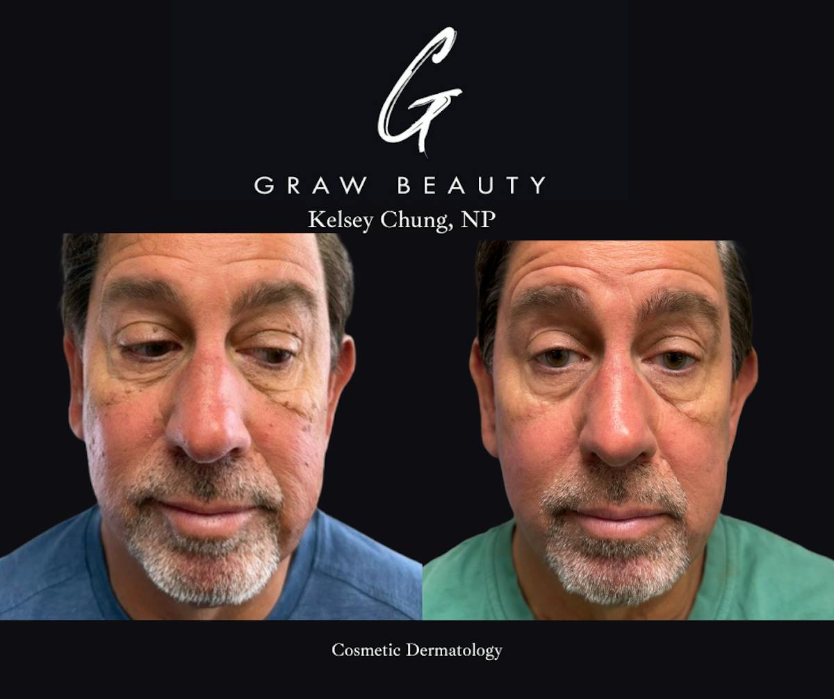 Face and Neck Before & After Gallery - Patient 450733 - Image 1