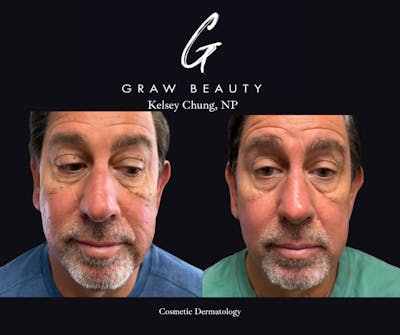Face and Neck Before & After Gallery - Patient 450733 - Image 1