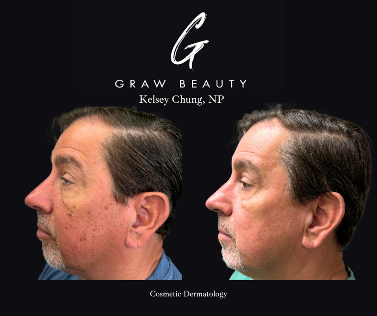 Face and Neck Before & After Gallery - Patient 450733 - Image 3