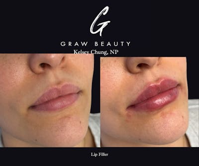 Face and Neck Before & After Gallery - Patient 108528 - Image 1