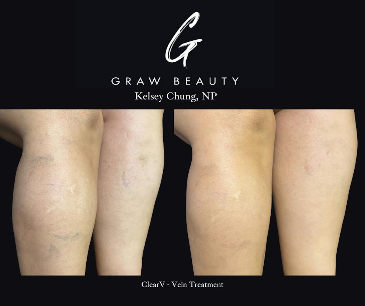 Vein Treatment Before & After Gallery - Patient 468528 - Image 1