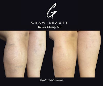 Vein Treatment Before & After Gallery - Patient 468528 - Image 1