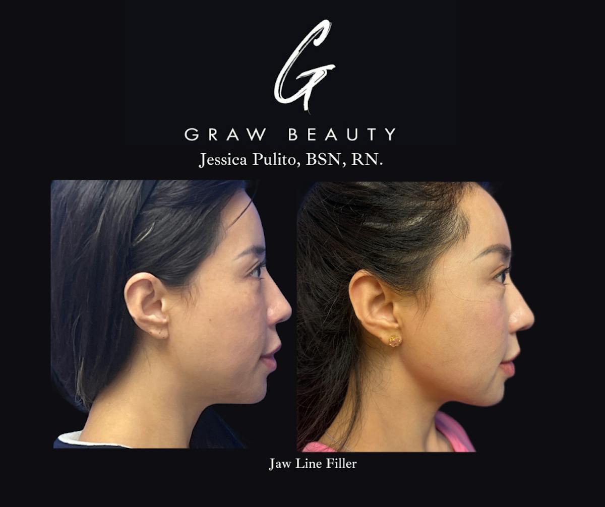 Dermal Filler Before & After Gallery - Patient 276375 - Image 2