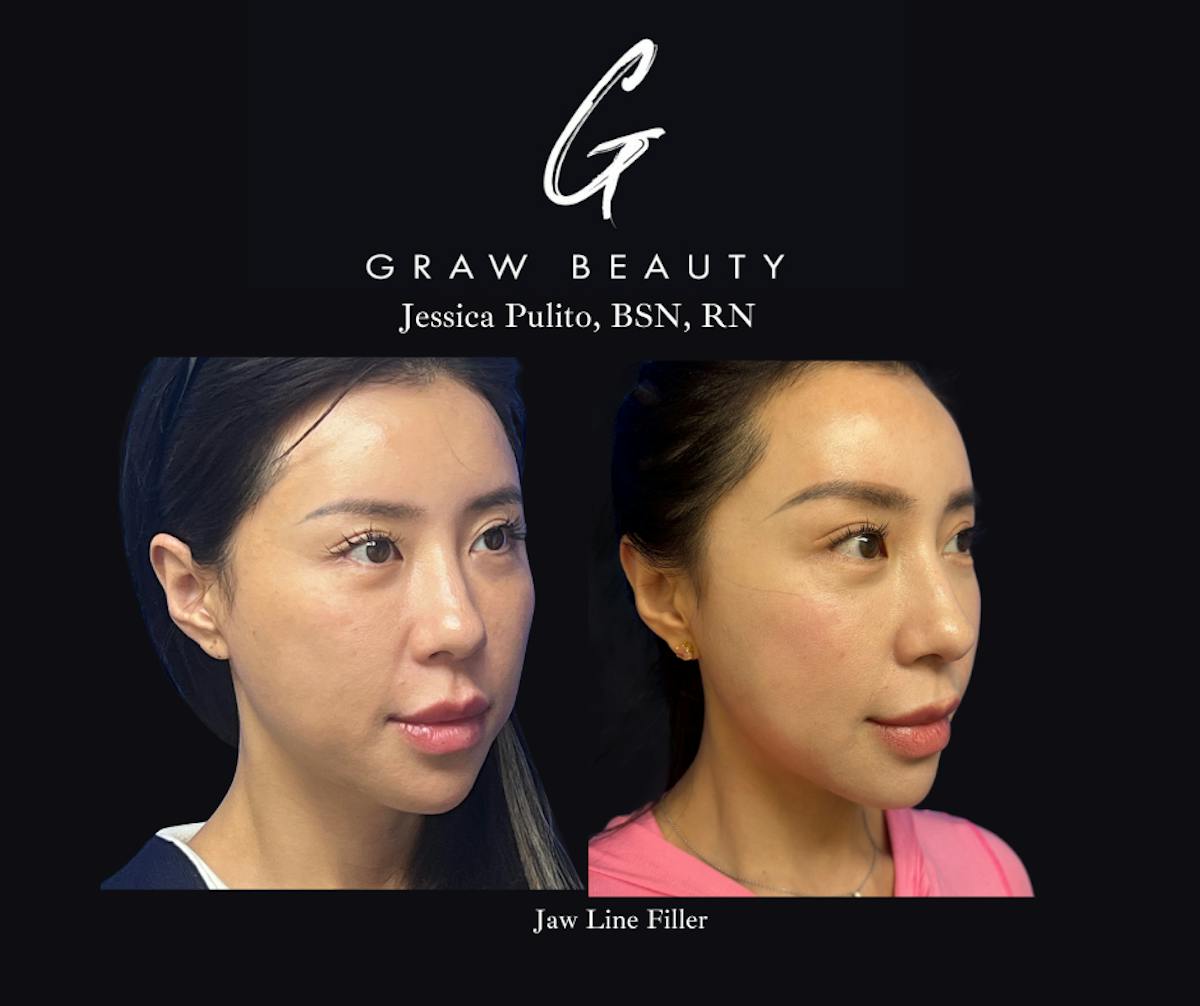 Dermal Filler Before & After Gallery - Patient 276375 - Image 1