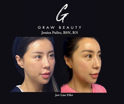 Dermal Filler Before & After Gallery - Patient 276375 - Image 1