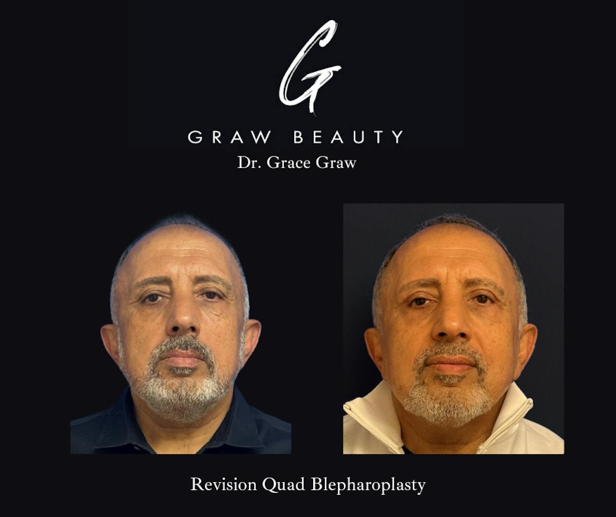 Eyelids Before & After Gallery - Patient 318074 - Image 1