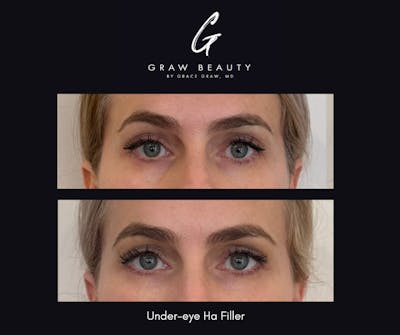 Dermal Filler Before & After Gallery - Patient 281214 - Image 1