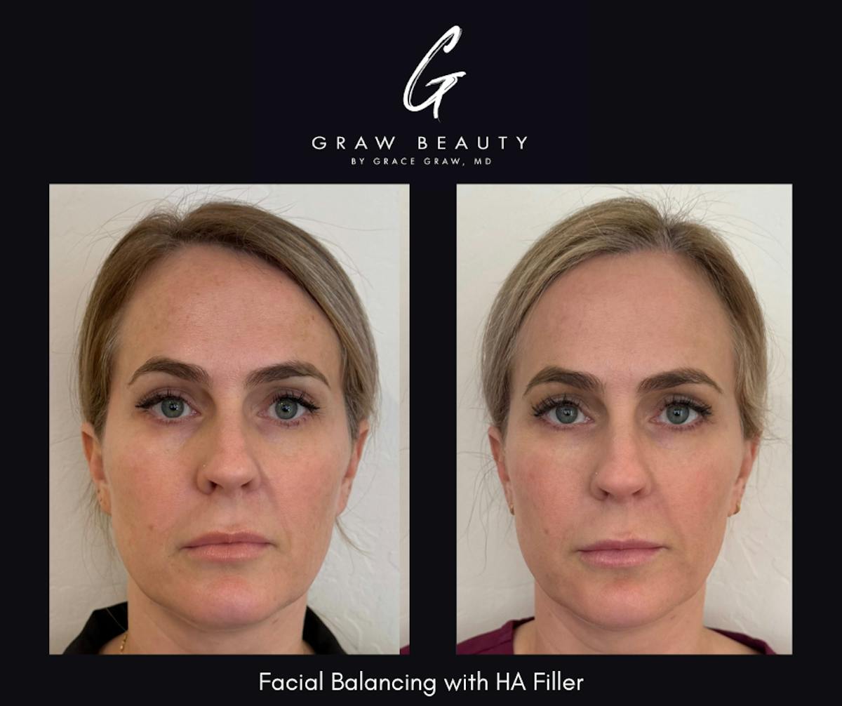 Dermal Filler Before & After Gallery - Patient 192488 - Image 1
