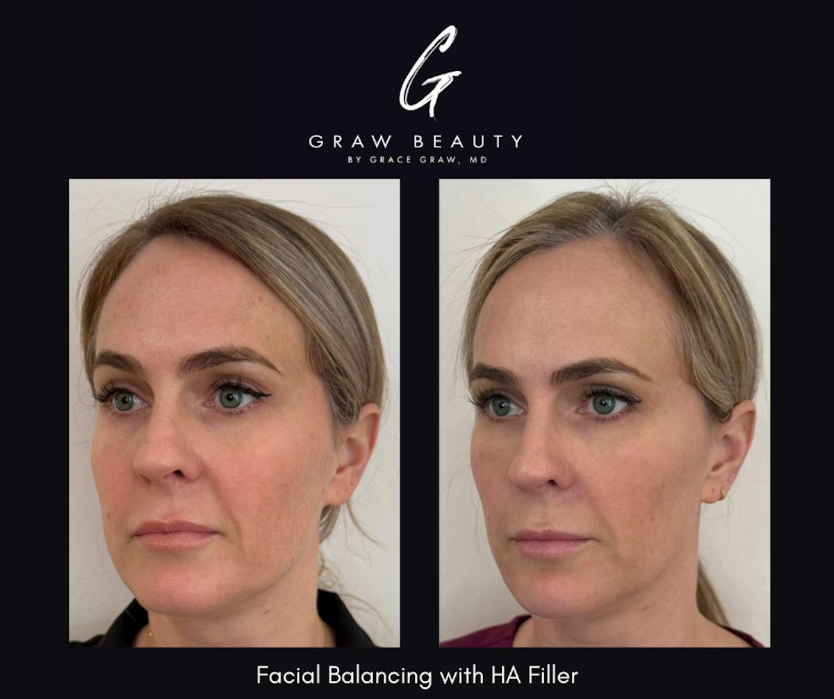 Dermal Filler Before & After Gallery - Patient 192488 - Image 3