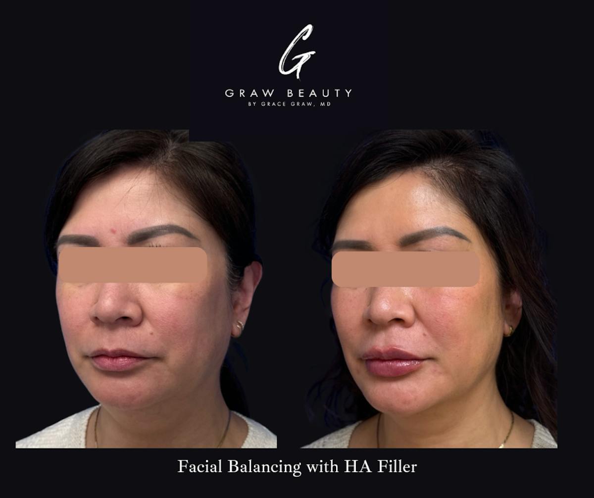 Dermal Filler Before & After Gallery - Patient 330236 - Image 4