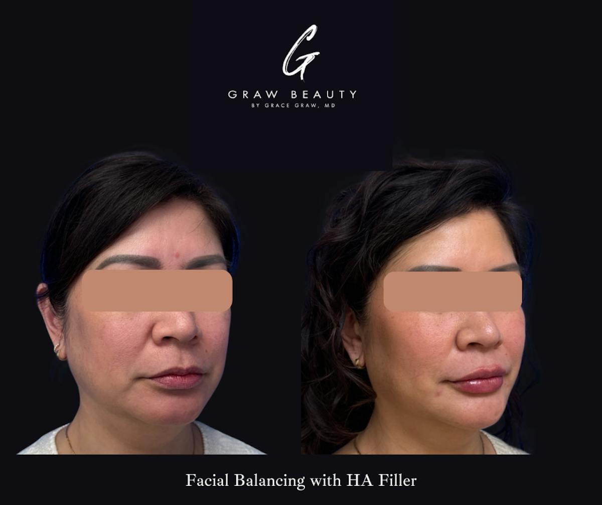 Dermal Filler Before & After Gallery - Patient 330236 - Image 2