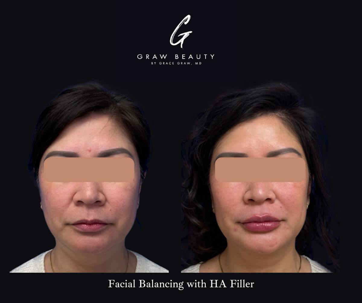 Dermal Filler Before & After Gallery - Patient 330236 - Image 1