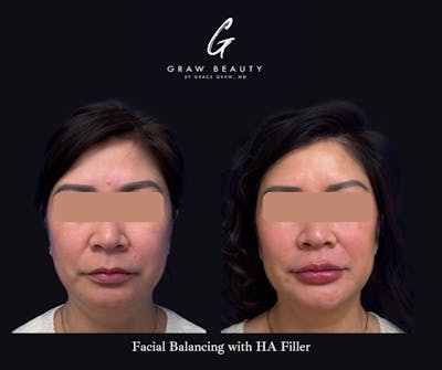 Dermal Filler Before & After Gallery - Patient 330236 - Image 1