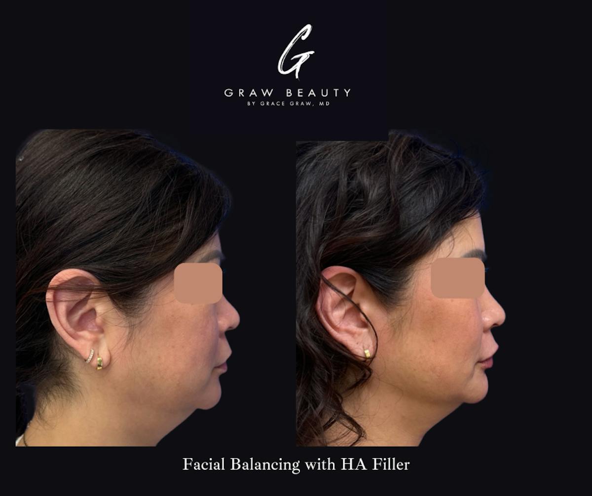 Dermal Filler Before & After Gallery - Patient 330236 - Image 3