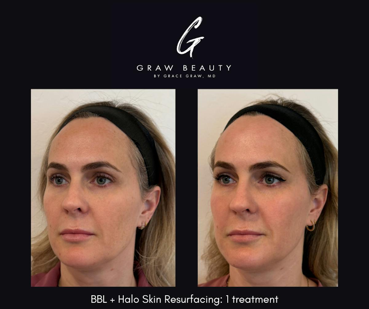 Laser Skin Resurfacing Before & After Gallery - Patient 912912 - Image 2