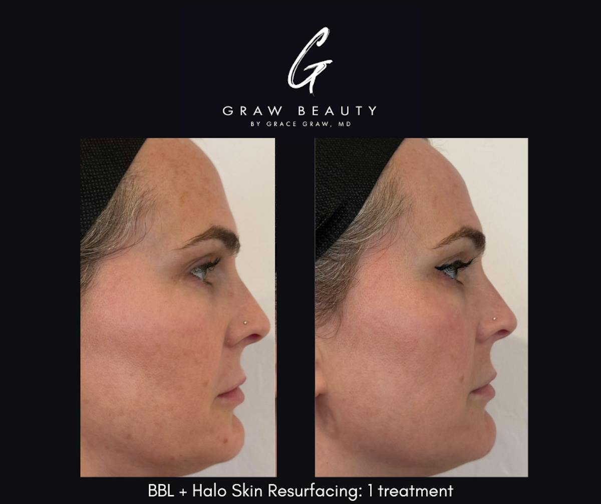 Laser Skin Resurfacing Before & After Gallery - Patient 912912 - Image 1
