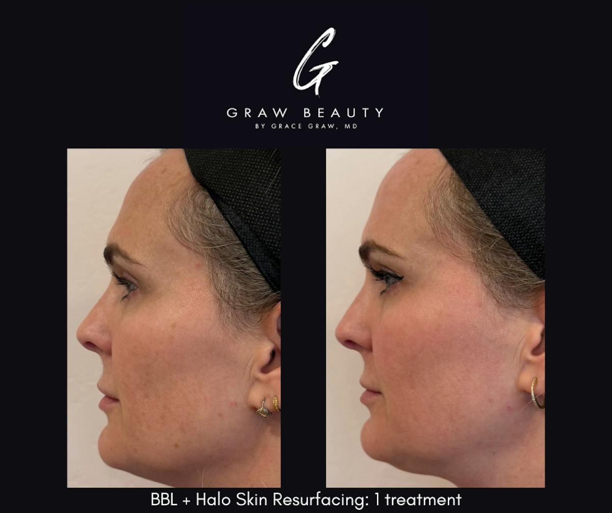 Laser Skin Resurfacing Before & After Gallery - Patient 912912 - Image 3
