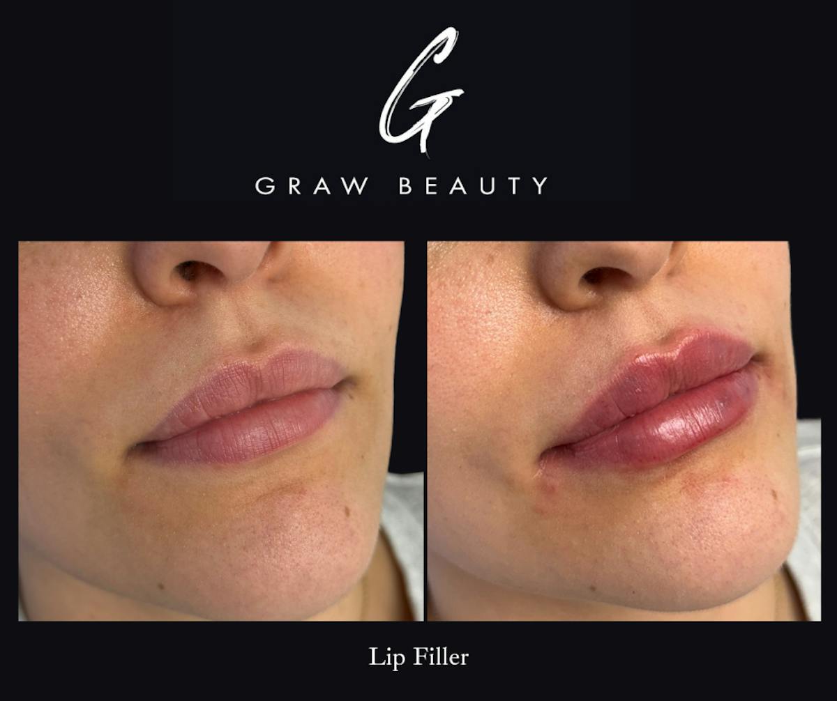 Dermal Filler Before & After Gallery - Patient 107574 - Image 1