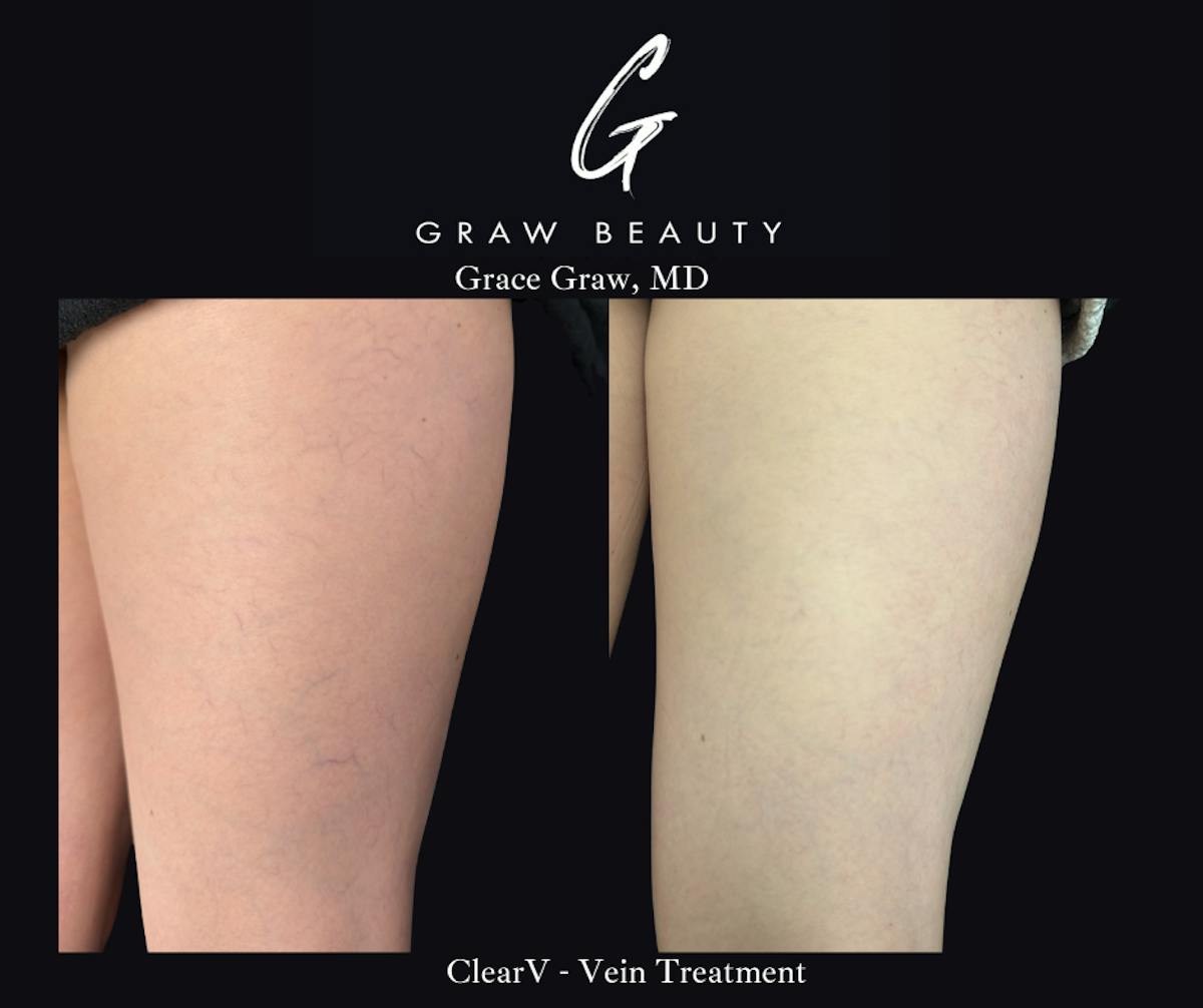Vein Treatment Before & After Gallery - Patient 223766 - Image 1