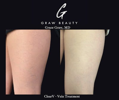 Vein Treatment Before & After Gallery - Patient 223766 - Image 1
