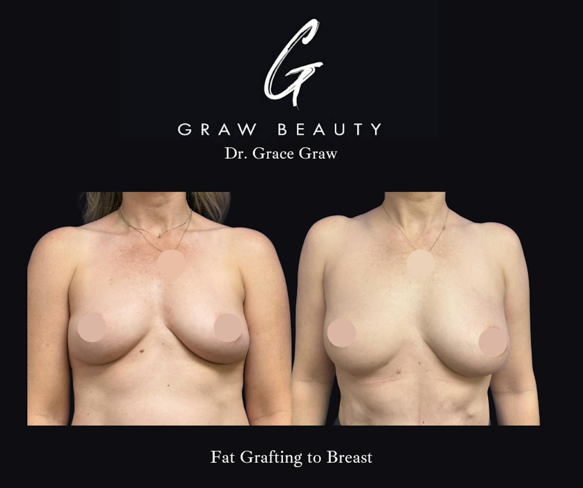 Fat Grafting Before & After Gallery - Patient 258741 - Image 1