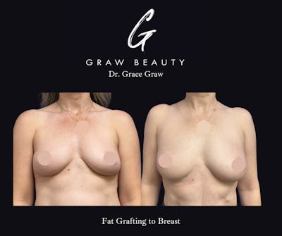 Fat Grafting Before & After Gallery - Patient 258741 - Image 1