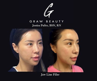 Dermal Filler Before & After Gallery - Patient 339990 - Image 1