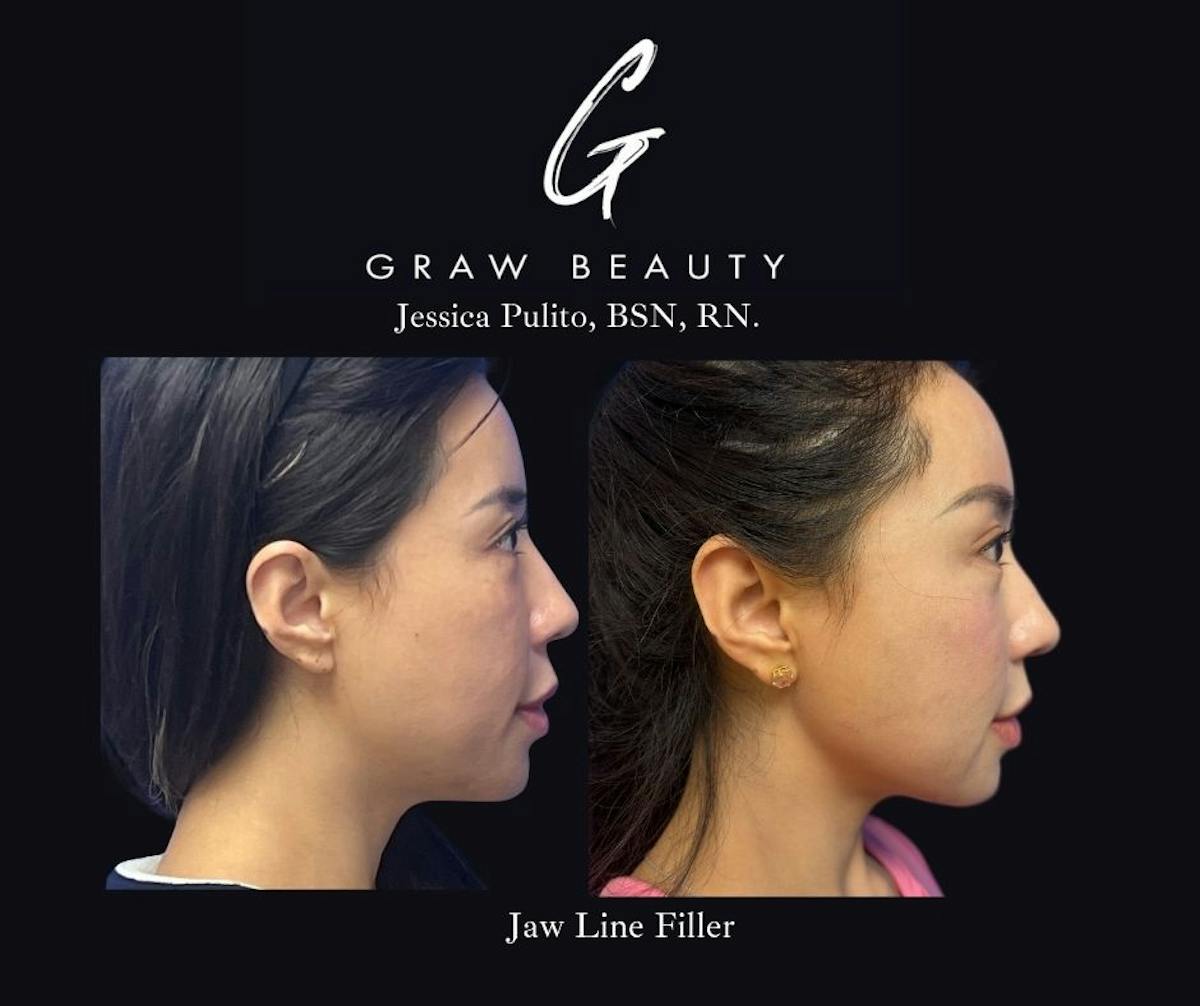 Dermal Filler Before & After Gallery - Patient 339990 - Image 2