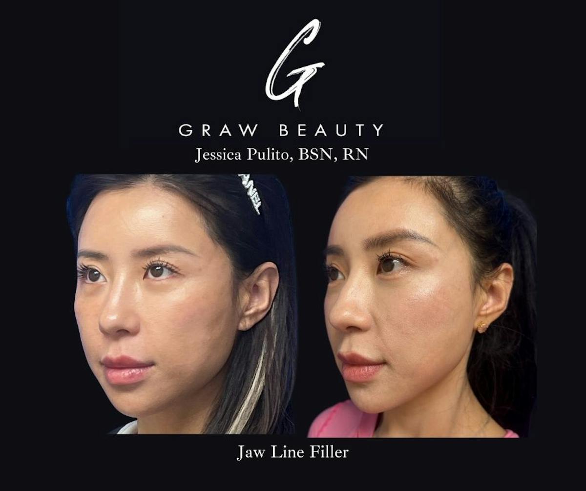 Dermal Filler Before & After Gallery - Patient 339990 - Image 3