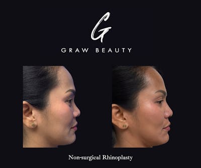 Dermal Filler Before & After Gallery - Patient 222801 - Image 1