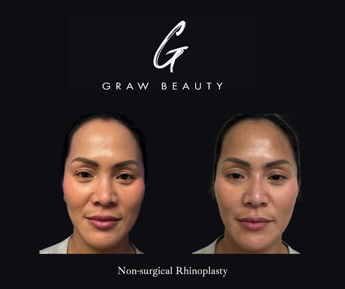 Dermal Filler Before & After Gallery - Patient 222801 - Image 2