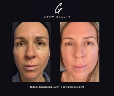 Laser Skin Resurfacing Before & After Gallery - Patient 734572 - Image 1