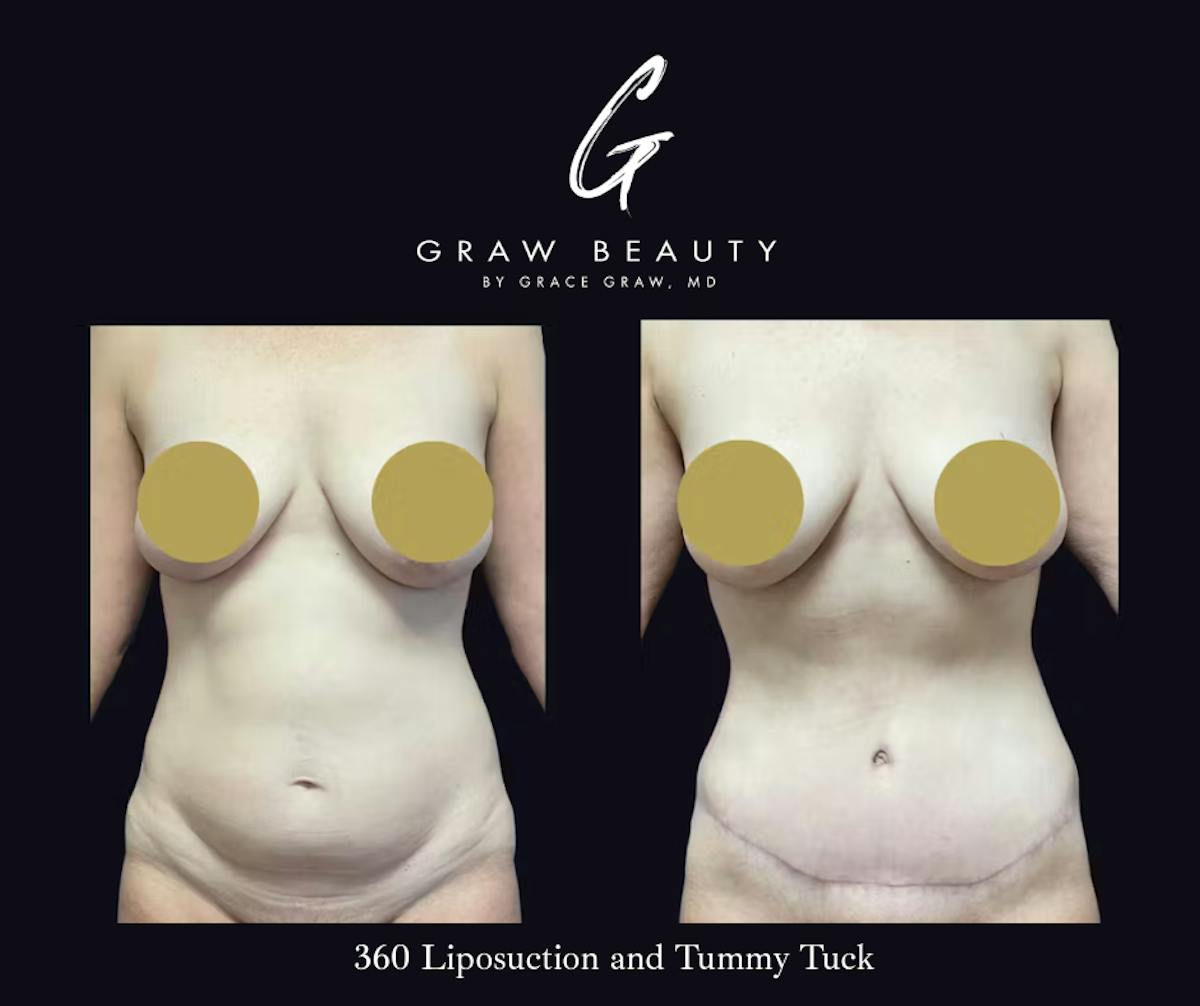 Abdominoplasty Before & After Gallery - Patient 122446278 - Image 1