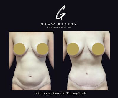 Abdominoplasty Before & After Gallery - Patient 122446278 - Image 1