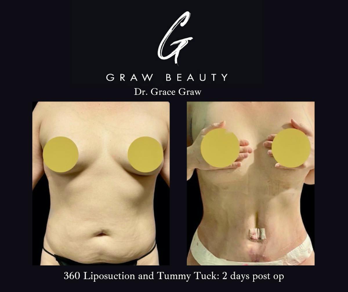 Abdominoplasty Before & After Gallery - Patient 328399 - Image 1