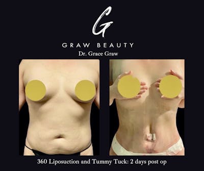 Abdominoplasty Before & After Gallery - Patient 328399 - Image 1