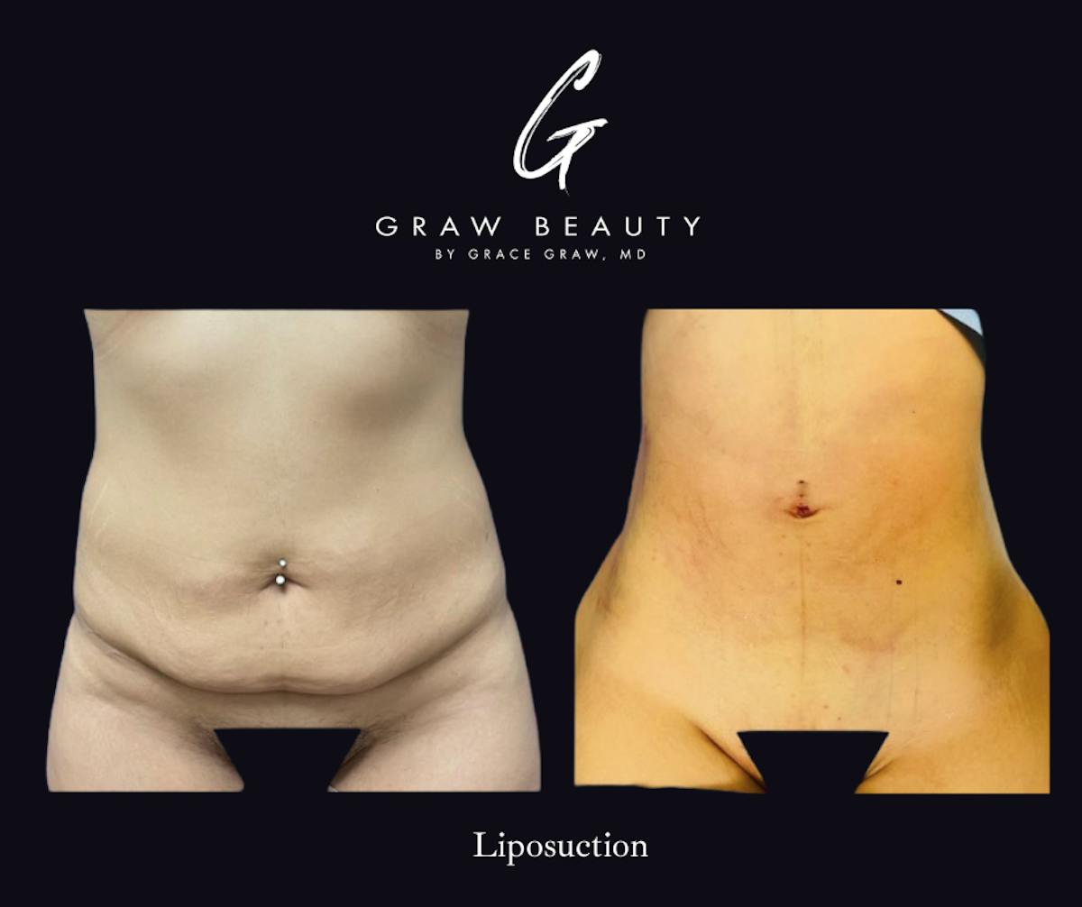 Liposuction Before & After Gallery - Patient 331762 - Image 1