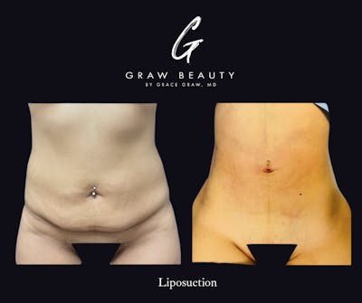 Liposuction Before & After Gallery - Patient 331762 - Image 1